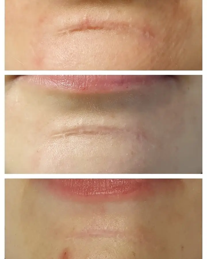 säker behandling av ärr stockholm